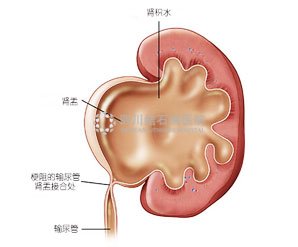 肾积水