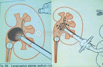 腹腔镜治疗肾积水