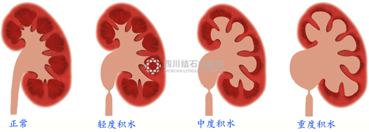 肾积水症状