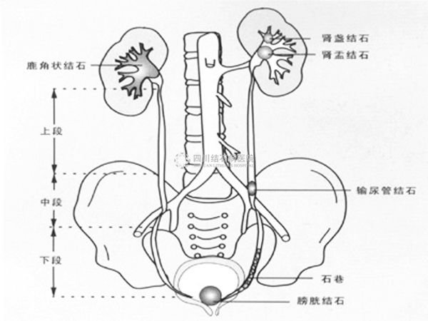 梗阻